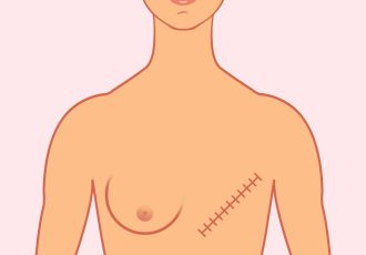 implantes de seno precio